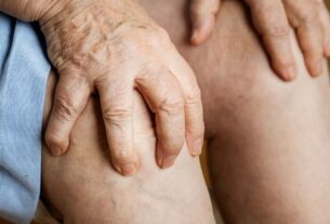 Pernas cansadas e varizes: entenda a insuficiência venosa crônica que afeta milhões de brasileiros
