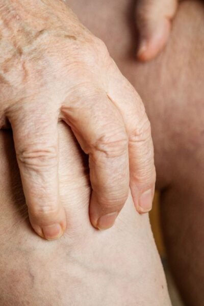 Pernas cansadas e varizes: entenda a insuficiência venosa crônica que afeta milhões de brasileiros