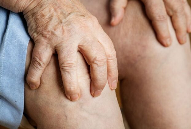 Pernas cansadas e varizes: entenda a insuficiência venosa crônica que afeta milhões de brasileiros