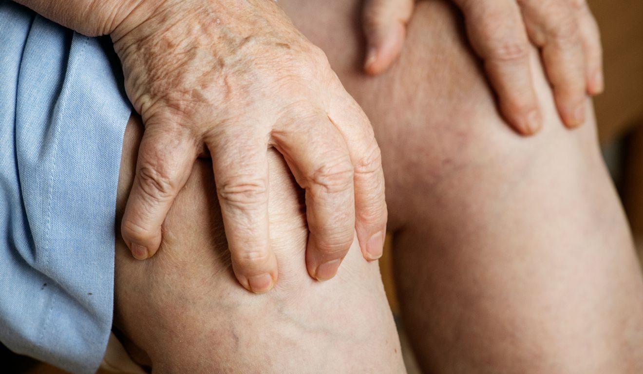 Pernas cansadas e varizes: entenda a insuficiência venosa crônica que afeta milhões de brasileiros 1 Pernas cansadas e varizes: entenda a insuficiência venosa crônica que afeta milhões de brasileiros